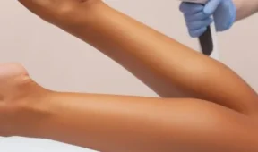 Depilacja laserowa nóg podczas profesjonalnego zabiegu